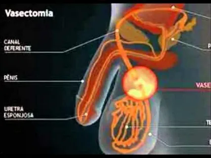 Vasectomy and Testicular Macrophage Reprogramming